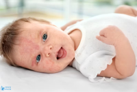 آلرژی ریه در نوزادان علائم، علت و راه های درمان