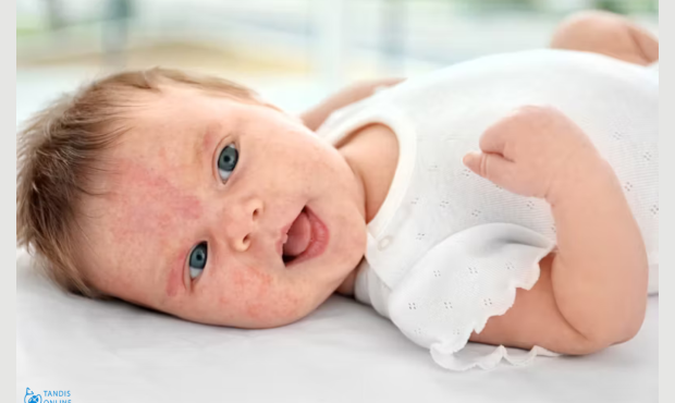 آلرژی ریه در نوزادان علائم، علت و راه های درمان
